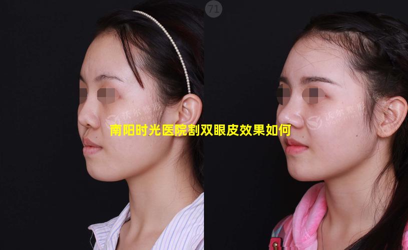 南阳时光医院割双眼皮效果如何